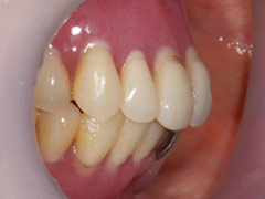 義歯治療前2