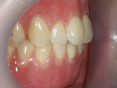 義歯治療後2