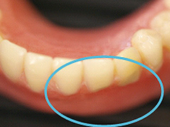 義歯治療12