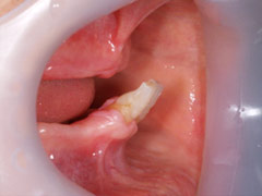 義歯治療2