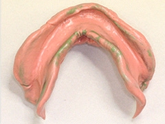 義歯治療14