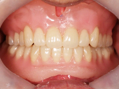 義歯治療21