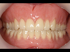 義歯治療28
