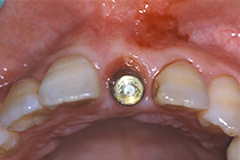 歯冠と仮の土台の結合1