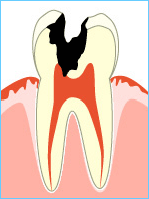 虫歯進行のC3画像