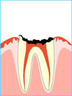 虫歯進行のC4画像