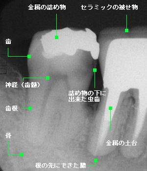 治療されている歯のレントゲン写真例1