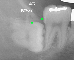 治療されている歯のレントゲン写真例2