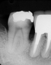 歯内療法治療例１