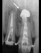 歯内療法治療例2
