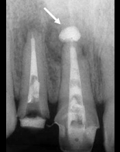 歯内療法治療例2-2