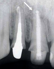 歯内療法治療例2-4