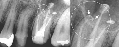 歯内療法治療例5