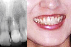 審美歯科治療後3レントゲン写真