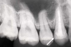 審美歯科治療前4レントゲン写真2