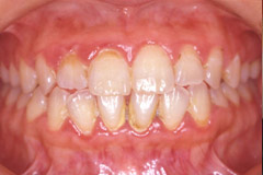 歯周病治療前1
