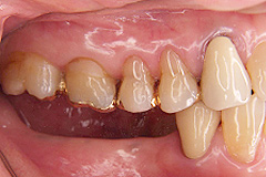 歯周形成治療前３