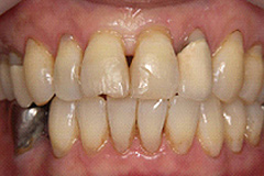 歯周形成治療前４