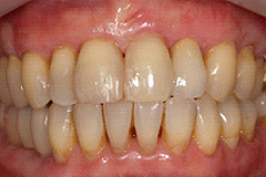 歯周形成治療後４
